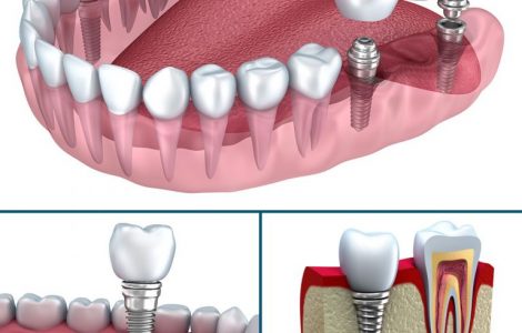 Hamilelikte diş implantı tedavisi yaptırmak riskli midir?