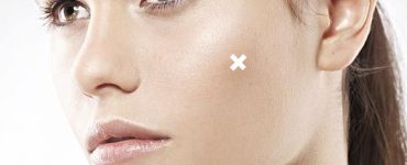 Mersin Leke Tedavisi